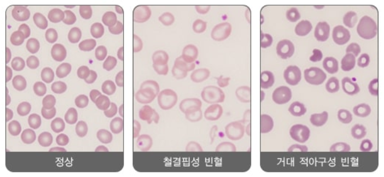 오포한의원 만성피로와 빈혈 관계